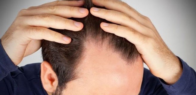 caida-de-pelo