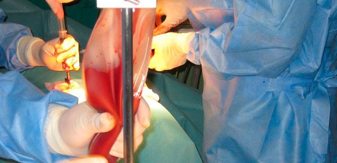 transplante-de-medula