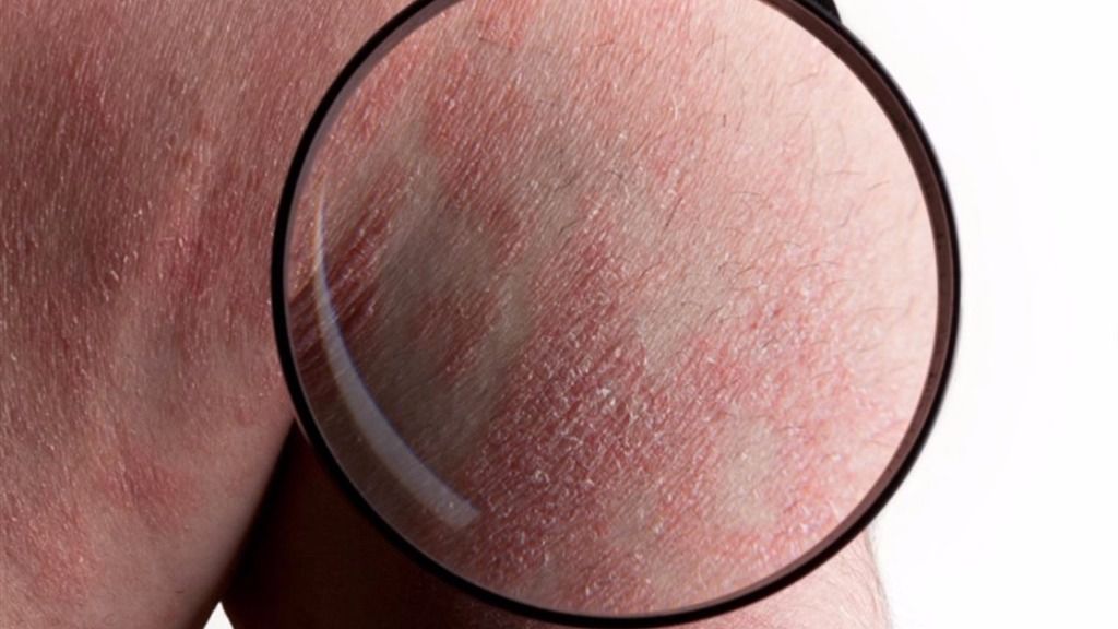 La psoriasis está vinculada a la diabetes y la obesidad