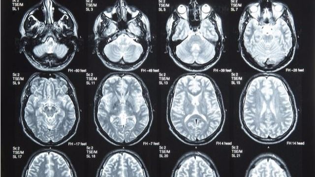 Imágenes del cerebro
