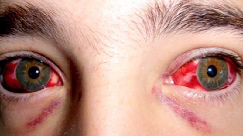 Dos nuevos casos de posible fiebre hemorrágica Crimea-Congo