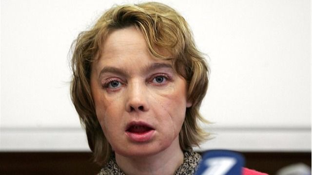 Muere la primera mujer que se sometió a un trasplante de cara