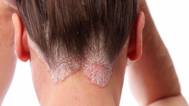 Adelgazar reduce la psoriasis