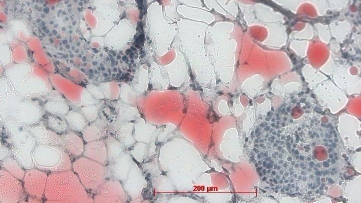 Descubren que el hígado graso puede causar daños a otros órganos