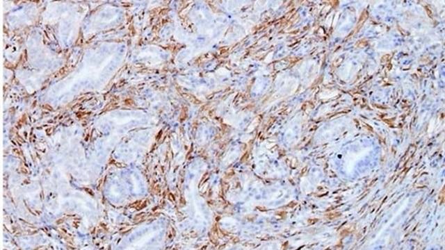 Descubren que inhibir una proteína podría frenar el cáncer de páncreas
