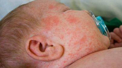 Espectacular epidemia de sarampión en Francia, Alemania, Italia, Reino Unido, Grecia y Rumanía