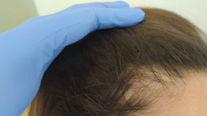 “La intensa pérdida del cabello de muchos pacientes de Covid tiene solución médica”
