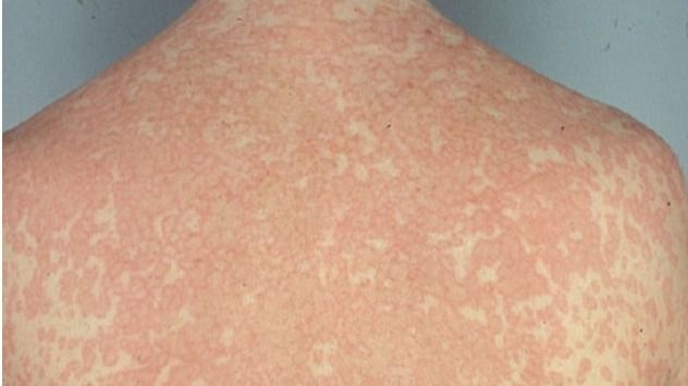 Más del 70 por ciento de pacientes etiquetados como alérgicos a la penicilina no lo son