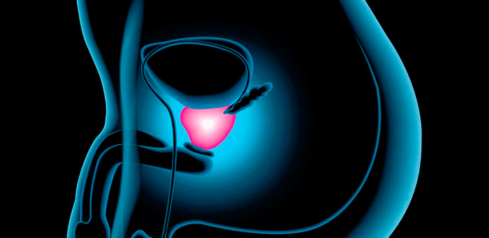 Cómo reducir el riesgo de cáncer de próstata