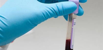 Una analítica podría sustituir las biopsias en cáncer de pulmón