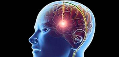 La estimulación intracraneal reduciría el avance del parkinson